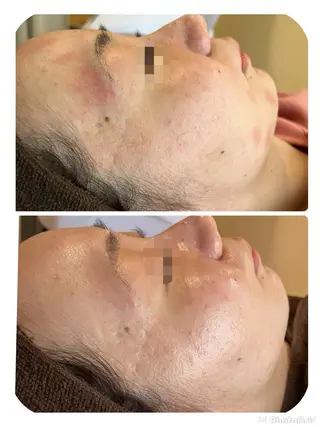 【リベルハーブピーリング認定店】敏感肌・美白脱毛専門店Dione立川店所属・Dione 立川店のエステ・リラクイメージ