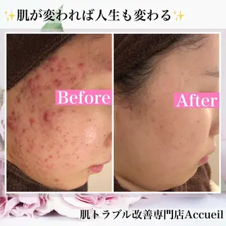 🔥3か月で肌革命 🔥ニキビ専門店のエステ・リラクイメージ