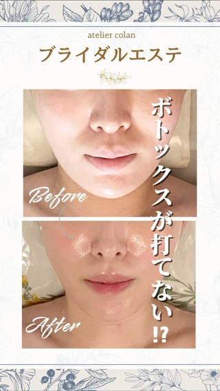 \今日はボトックス打てません/
そうドクターに言われて、驚いたお客様

実は以前まで
3ヶ月に1度ボトックスが欠かせない状態だったそう

でもcolan式“擦らない小顔コルギ”に通ううち
“筋肉の強張り”がなくなって
医療施術が見送りになったそうです。

︎通うたびに少しずつ変わるフェイスライン 
︎強さではなく、深さでアプローチ 
︎根本からの変化を目指せる持続型ケア

美容医療も、コルギも、 
どちらが正解ではなく“選択肢”です。 
でも「もう打たなくてよくなった」って
言ってもらえるのは  とっても嬉しい

擦らないのに深く効く 
#colan式小顔コルギ 
ぜひ体感してください 