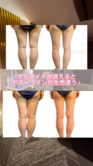 万年気になってしまう浮腫み…セルライト…
ここさえスッキリしてくれれば…とお悩みの方

当サロンではハイパーナイフ＋キャビテーション＋全身マッサージの最強フルコンボで、落ちにくい脂肪の塊もしっかり流します

まずは初回体験にぜひご来店ください 