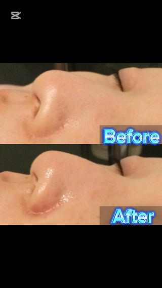 ふわふわ泡洗顔→AHAピーリング→毛穴洗浄で
ツルツルお肌に
毛穴に悩んでる方はぜひお試しくださいね 