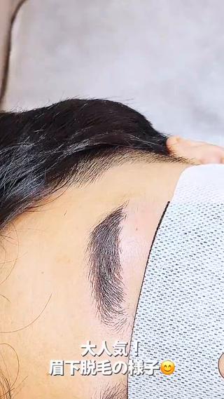 眉下脱毛の様子です 