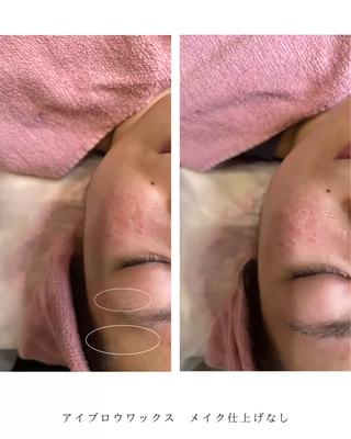アイブロウワックス脱毛の症例
︎女性
︎アイブロウ(眉)
ハードワックスでやっていきます。
まず、デザインをお客様と相談しながらデッサン
平行がお好きとのことで枠取りしながらやっていきました。毛根から抜いていくので2.3週間は生えてきません。
自己処理がぐーんと短くなります。
あとは、古い角質もとれるので全体的に綺麗になります!
赤みやポツポツは出る可能性はありますが大半の人は次の日〜3日以内に引いていきます。
※個人差はあります※
※メイクお仕上げなし※
Instagramにもっと症例写真を載せています。