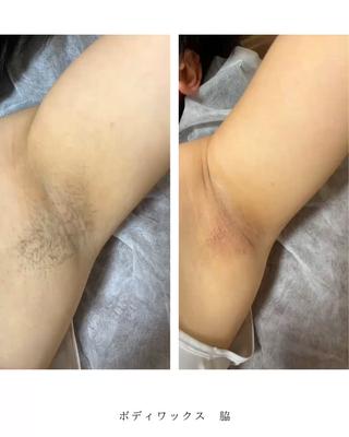 ボディワックス脱毛の症例
︎男性
︎脇
ハードワックスでやっていきます。
この夏、気になる脇をワックスで処理
毛根から抜いていくので3週間〜1ヶ月ぐらいは
ツルツルです。
自己処理がぐーんと短くなります。
あとは、古い角質もとれるので全体的に綺麗になります!
赤みやポツポツが出る可能性はありますが大半の人は次の日〜3日以内に引いていきます。
※個人差はあります※
Instagramにもっと症例写真を載せています。