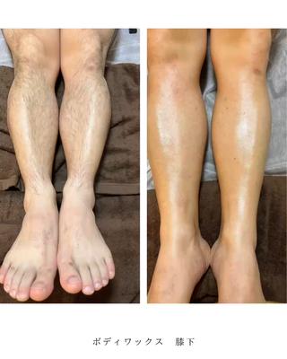 ボディワックス脱毛の症例
︎男性
︎膝下(膝含む)
ストリップワックスでやっていきます。
この夏、気になる膝下をワックスで処理
毛根から抜いていくので3週間〜1ヶ月ぐらいは
ツルツルです。
自己処理がぐーんと短くなります。
あとは、古い角質もとれるので全体的に綺麗になります!
赤みやポツポツが出る可能性はありますが大半の人は次の日〜3日以内に引いていきます。
※個人差はあります※