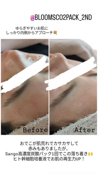 おでこが肌荒れで赤くなりカサカサしていましたがSangoの炭酸パック1回でここまで鎮静されました 