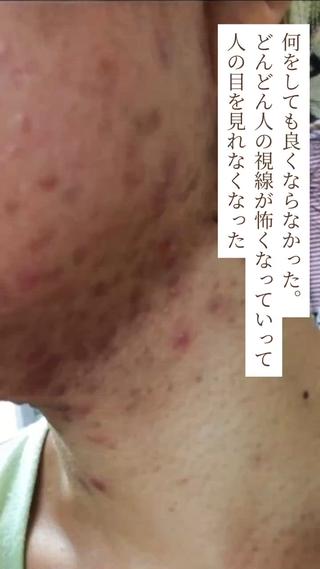 ニキビ・ 肌荒れ専門店のエステ・リラクイメージ