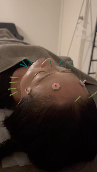 美容鍼×小顔矯正 ×美容整体　浜川泰仁のエステ・リラクイメージ