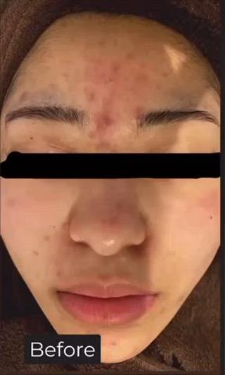ハーブピーリング、before  after動画

写真より、もっともっとbefore afterが
分かりやすいので、ぜひぜひご覧あれー

ディープクレンジング→濃密泡洗顔→ホットタオル→毛穴吸引→ハーブ導入→保湿＋鎮静パック→お仕上げ、、、 