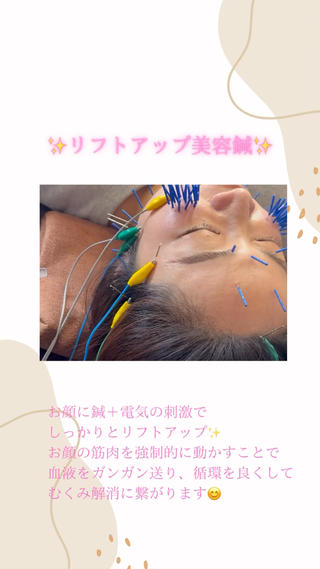 ️プレミアム美容鍼️
美容鍼+電気の刺激で、お顔を徹底的にアプローチ！
使えていない筋肉は、動かして鍛えて
使いすぎている筋肉は、緩めていきます 