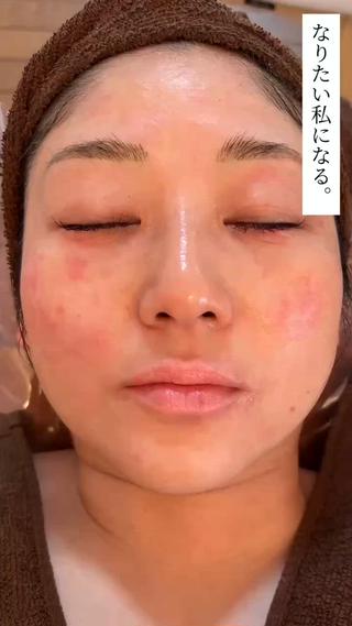 当サロンのハーブピーリング