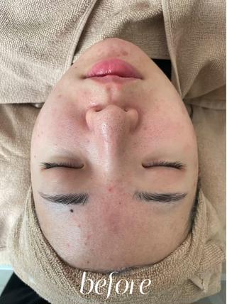剥離なしハーブ【施術前と施術後】ビフォーアフター
1回で毛穴、トーンアップ！かなり変化してませんか？

剥離なしハーブは施術中の痛み、施術後のダウンタイムは無いのでデートや大事なイベント前にとてもオススメです 