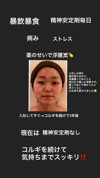 隠れ家サロンヨルムです

私自身の体験なのですが
学生時代から社会人になって、
ずっと精神安定剤を飲み続けていました。

気持ちの上がり下がりが激しく
薬の影響でむくみや暴飲暴食
異常な眠気などにも悩まされました。

そこでコルギサロンに出会い働き始めて
6年、練習も含め何回もコルギを受けてきました。

初めに職場の先輩からはコルギを続けると
自律神経も整い
『薬を手放せるようになるよ』と言われていまし
たが全く信じていませんでした。

ですが、日に日にお顔もスッキリ
身体に力が入っていたのがゆるっとほぐれ
今では薬無しでお仕事ができております
 