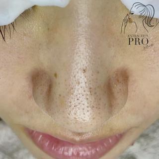 当店は、毛穴エクストラクションプロ認定サロン　です⠀
⠀
●毛穴エクストラクションとは？？⠀
⠀
長年の毛穴の黒ずみ、角栓つまり、しつこいザラつき皮脂詰まりなどを独自の方法でマシーンを使わず、毛穴ひとつひとつを観察しながら丁寧に取り除いていくとても繊細で高度なテクニックを要する毛穴ケア技術のことです。⠀
⠀
⠀
これまでの"毛穴エクストラクション"は、施術中に激しい痛みや赤みを伴う事も多く、施術後のヒリつき・赤み・剥離もひどく出てしまうため、それが苦手で毛穴の悩みを解消したいけれど諦めた、、、という他店経験のお客様のお声を耳にする事がありました。⠀
⠀
⠀
しかし、［毛穴エクストラクションプロ］は、プロとして、より安全で繊細な方法で行う事により、赤みや痛み、ヒリつきを可能な限り最小限にし、そして汚れを取り除いた後の毛穴引き締め・鎮静までもしっかり行うことで安心して受けて頂ける技術です⠀
⠀
⠀
これまで他店の毛穴エクストラクション、毛穴エステ、クリニックでのケア、自宅でのセルフケアで解消されなかった頑固な毛穴悩みは［毛穴エクストラクションプロ］にお任せください⠀
⠀
⠀
●毛穴エクストラクションプロ認定サロンとは？⠀
⠀
日本一厳しいと言われている毛穴専門エステスクール⠀
⠀
　@la.beaute.esthe⠀(Instagram)
⠀
の厳しいテストに合格し、合格者の中でも規定を満たしたプロフェッショナルなサロンのみが名乗ることができる称号です。⠀
⠀
このロゴマークがあるサロンのみが正規認定サロンとなります⠀
⠀
施術を受けたその日だけツルツルになればいい　のではなく、その後も効果を長く感じて頂け、お客様の毛穴のお悩みを確実に解消していくために、⠀
⠀
毛穴ケアのプロフェッショナルとして、お客様のあらゆる毛穴のお悩みと向き合い施術＋アドバイスさせて頂きますので、是非お任せください^ ^⠀
⠀
RIRE. (リール)esthetic:noriko⠀
⠀
#毛穴エクストラクションプロ認定サロン⠀
#毛穴エクストラクションプロ⠀
#毛穴エクストラクションプロ東京⠀
#毛穴エクストラクション⠀
#毛穴エクストラクション東京⠀
#エクストラクション⠀
#エクストラクション東京⠀
#エクストラクション毛穴⠀
#毛穴ケア#毛穴黒ずみ#毛穴開き 