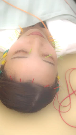 美容鍼が主に効果が期待出来るのは、【たるみ】と【むくみ】です！！ 