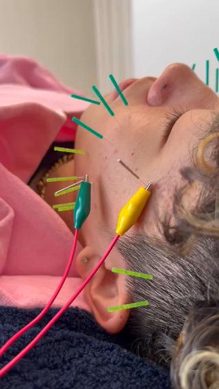 メンズ 美容鍼×小顔×姿勢× ブライダル整体のエステ・リラクイメージ