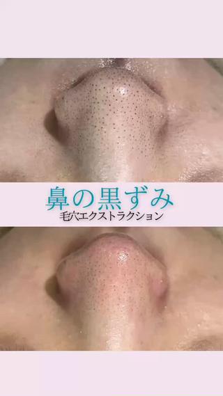 毛穴エクストラクションで毛穴の黒ずみごっそりお掃除長年のお悩み解決します 