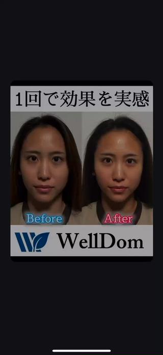 小顔矯正90分コース1回で効果を実感して頂きました!
見て実感!触れて実感!
施術中の痛みを感じにくいことにもこだわっておりますが、
効果は見ていただいた通りです!