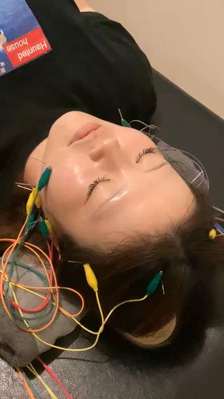お試し美容鍼で一回でも効果を実感

通常の施術ならもっと鍼が増えて最大限の効果が期待できます！ 