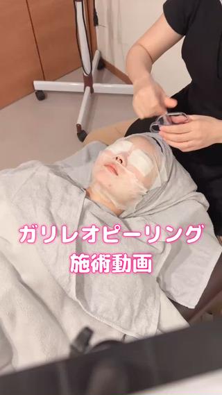 強炭酸ピーリングの施術動画です