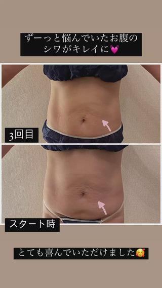 3度の出産で伸びてしまったお腹の皮膚
ずっと悩んでいて、クリームを塗ったり腹筋を
付けようと運動したり…

しかし、自分ではどうする事もできず
諦めていたそう


先日、セルライトゼロの体験をされて
これなら
と、希望を持っていただき
腹部集中コースで通っていただけることに
なりました。


3回目の施術でこんなにも変化が

そうなんです！
セルライトゼロは痩せるだけじゃなく
お肌のトリートメント効果も
凄く高いんです


Y様
来年の夏にはビキニを着るのを目標に
頑張っています


素敵な目標
私も全力でサポートさせていただきます！


次は更に絞っていき、キレイなくびれを
作っていきます

みなさん楽しみにしていてくださいね 