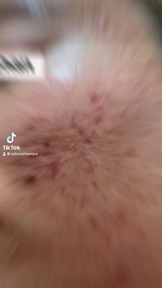 ニキビ根本改善コースで10回目お肌が綺麗になりました。
 