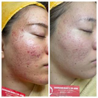 10回ニキビ根本改善コース 