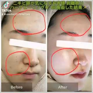 ハーブピーリング 専門店MOKA所属・ハーブピーリング専門 MOKAのエステ・リラクイメージ