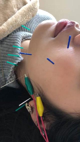 リフトアップのための電気鍼の様子です^_^ 