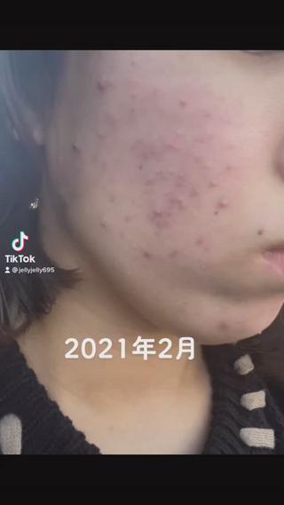ーエステについてー　
フェイシャル＋デコルテまでマッサージ　
『スッキリします』
　さらに、、　
＋¥1650〜￥2750で　
お客様のお悩みに合わせたアルゲパックも出来ます。　
　
・スキンケア頑張っても肌質改善が出来ない... 
・プロのアドバイスが欲しい　
・どこのエステサロンが良いのか分からない... など　
是非1度カウンセリングをさせて下さい　
.
お気軽にご予約お待ちしております
   
【初回エステmenu】　
・スタンダードコース50分￥2200 
 
・1番人気　『肌荒れニキビに』
スタンダードコース50分＋ビューネケアパック20分￥3850  
 
- [x] ・『毛穴のお悩みに』　　　
- [ ] スタンダードコース50分＋クリーンパック20分￥3850
　
ー当サロンアクセスー　　
お車でお越しの方へ　
無料駐車場3台あります。是非ご利用ください。

イオンモール福岡付近
西鉄バスをご利用のお客様へ

博多駅〜福岡太宰府線『32 』『33 』『34 』『370』『37』
で東志免バス停より　徒歩10分
TSUTAYA BOOKGARAGE 福岡志免最寄り︎吉原バス停の一つ手前の︎東志免です！

※路線『5』空港循環線をご利用の場合は、
新生バス停より徒歩5.6分
　
#新人セラピスト賞#メナードフェイシャルサロン#エステ#フェイシャルエステ#メナード#アルゲパック#スキンケア#薬用ビューネ#肌荒れ#ニキビ#生理前#糟屋郡#糟屋郡カフェ#福岡#成人式#イベント#福岡カフェ#likes 
