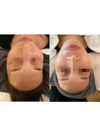 肌質改善 KALANCHOEのエステ・リラクイメージ