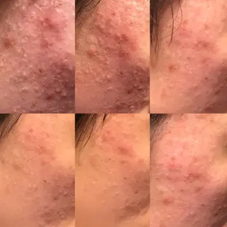 ニキビ&跡改善サロン オーナー光木のエステ・リラクイメージ