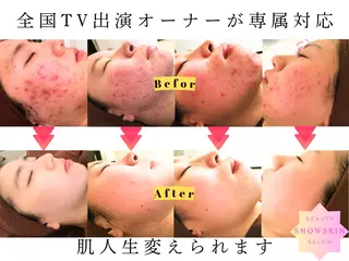 ニキビ/肌質改善専門 Snow skinのエステ・リラクイメージ