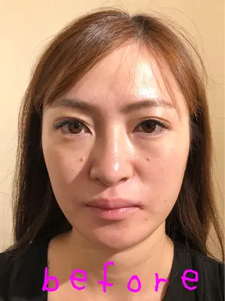 Acupuncture  salon LINOA リノア鍼灸院所属・ヘッドスパ鍼/小顔鍼 耳ツボ 　LINOAのエステ・リラクイメージ