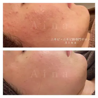 ショート カラー パーマ ヘアアレンジ メンズ キッズ ネイル アイブロウ ニキビ跡専門サロン Ainaのエステ・リラクイメージ