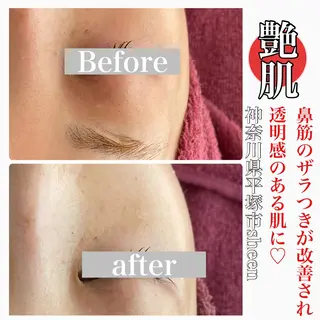 Chalon所属・REVI取扱・肌悩み 毛穴Chalonのエステ・リラクイメージ