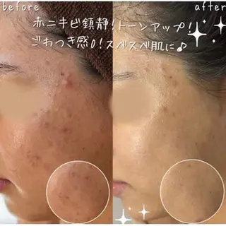 【ハーブピーリング/毛穴洗浄】NA skin 川崎店〜ニキビ・毛穴専門店〜所属・NAskin川崎 皆川のエステ・リラクイメージ