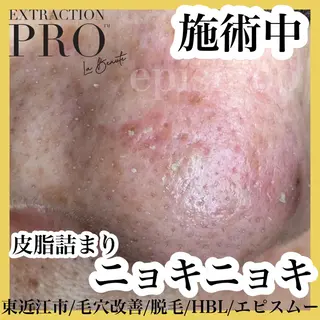 epismoo 脱毛/HBL/毛穴の眉毛・アイブロウイメージ