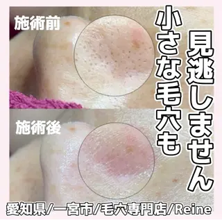 Reine BeautySalon所属・毛穴/シミ肝斑/脱毛 横山梨里のエステ・リラクイメージ