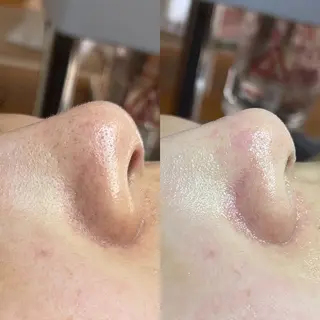毛穴専門店MeMe.八千代店所属・毛穴専門店👃 毛穴汚れごっそり✨のエステ・リラクイメージ