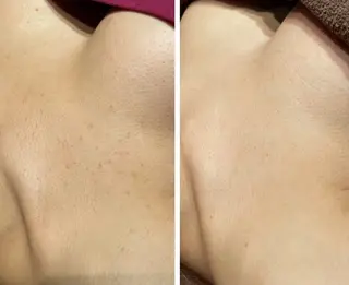 ハーブピーリング re:proのエステ・リラクイメージ