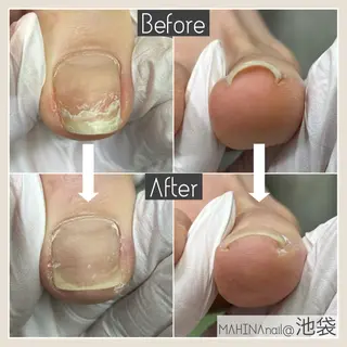 ネイル MAHINA nail所属・MAHINA/ネイル 巻き爪矯正/角質ケアのネイルデザイン