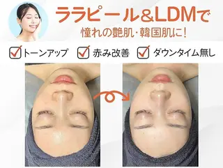 ニキビ・毛穴・肌荒れ ララピール×LDMのその他イメージ