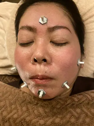 Acupuncture  salon LINOA リノア鍼灸院所属・ヘッドスパ鍼/小顔鍼 耳ツボ 　LINOAのエステ・リラクイメージ