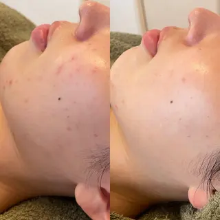 ニキビ毛穴改善 🌿ハーブピーリングのエステ・リラクイメージ