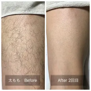 メンズ マンモス脱毛 札幌白石店のその他イメージ