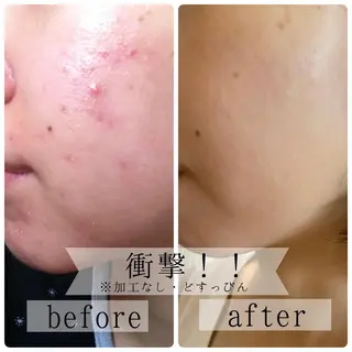 ニキビ特化美容鍼 ×ハーブピーリングのエステ・リラクイメージ