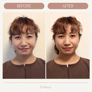 即効⚡小顔美容鍼🪡 むくみたるみ脂肪解消のエステ・リラクイメージ