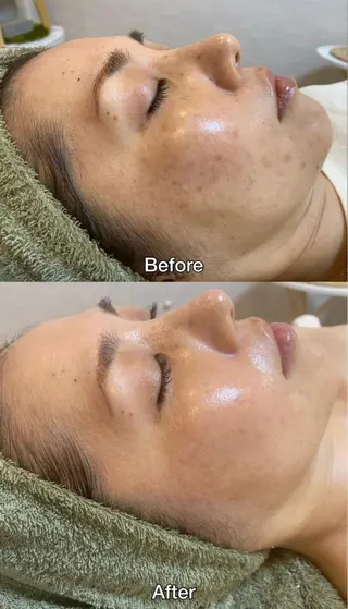 脱毛|肌質改善| ROOM.Sのエステ・リラクイメージ