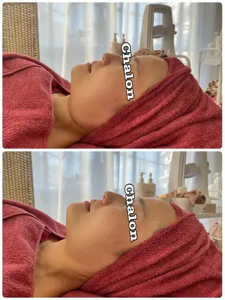 Chalon所属・REVI取扱・肌悩み 毛穴Chalonのエステ・リラクイメージ